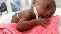 Sức sống bền bỉ của bé sinh non ở tuần 24 nặng 600 gram