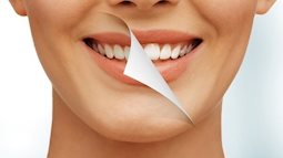 Nguy cơ có ngày “không còn răng mà ăn cháo” vì thuốc tẩy trắng răng