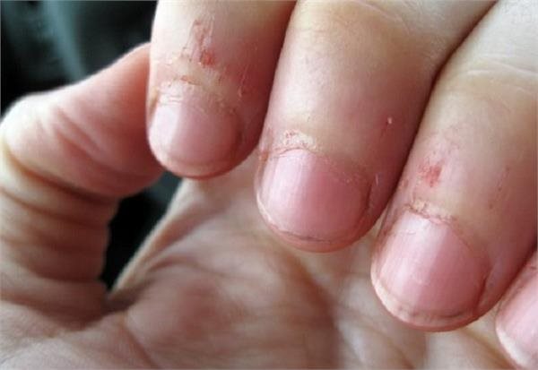 Coi chừng hoại tử phải cắt bỏ ngón tay vì vết xước măng rô - Làm cha mẹ