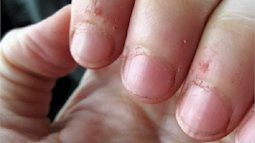 Coi chừng hoại tử phải cắt bỏ ngón tay vì vết xước măng rô