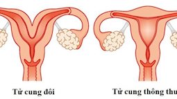 Thai phụ có 2 tử cung bị vỡ may mắn được bác sĩ cứu sống