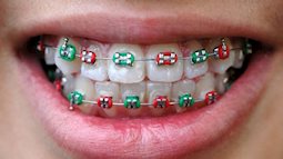 4 lưu ý bạn cần biết trước khi đi niềng răng làm đẹp 