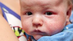8 căn bệnh về da phổ biến trẻ sơ sinh nào cũng dễ mắc, các mẹ đang nuôi con nhỏ nên lưu ý