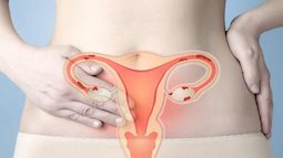 Nữ giới có nguy cơ cao mắc bệnh ung thư nội mạc tử cung nếu thuộc một trong những đối tượng sau