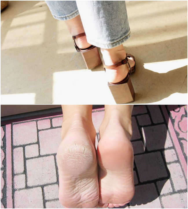 Có 3 cách rẻ bèo giúp làm mềm phần gót chân khô ráp, để các nàng diện đủ mọi kiểu giày dép hở mùa hè - Ảnh 2.