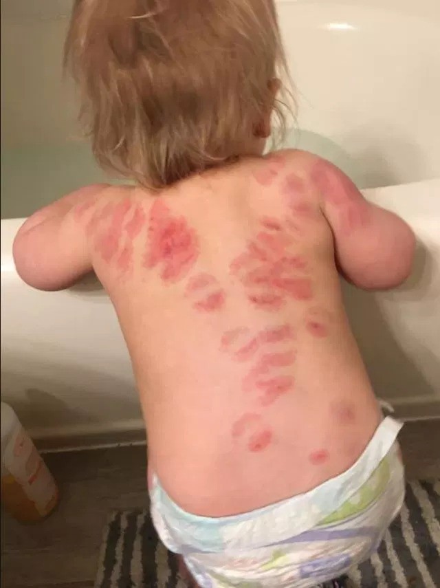 Đón con gái 10 tháng tuổi từ nhà trẻ, bà mẹ lập tức gọi báo cảnh sát khi phát hiện trên lưng đứa trẻ chi chít vết cắn - Ảnh 2.