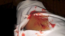 TP.HCM: Cô gái phải điều trị phơi nhiễm HIV sau khi bị 2 kẻ 'biến thái' tấn công bằng vật nhọn trong lúc dừng đèn đỏ