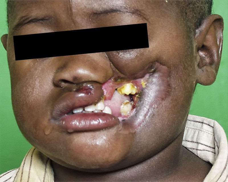 Noma - Căn bệnh kinh hoàng nhất thế giới, chỉ có 15% trẻ em sống sót sau cơn đau cấp tính - Ảnh 4.