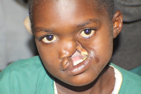 Noma - Căn bệnh kinh hoàng nhất thế giới, chỉ có 15% trẻ em sống sót sau cơn đau cấp tính - Ảnh 5.