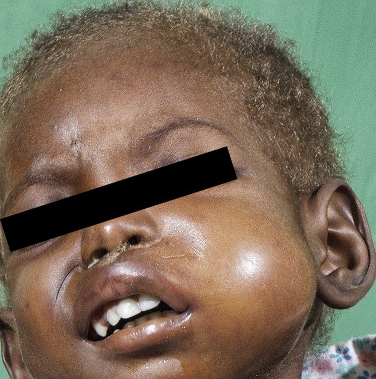 Noma - Căn bệnh kinh hoàng nhất thế giới, chỉ có 15% trẻ em sống sót sau cơn đau cấp tính - Ảnh 2.