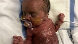 Em bé sinh ra không có da, nhìn như 'miếng thịt sống' đến bác sĩ cũng phải bật khóc vì thương cảm