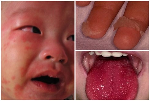 Trẻ em sốt nhiều ngày liên tục kèm mắt đỏ, coi chừng mắc bệnh hiếm này - Ảnh 1.
