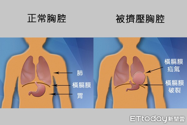 Người đàn ông 45 tuổi mắc bệnh ung thư trực tràng, táo bón suốt nhiều ngày chỉ vì thói quen này khi đi đại tiện - Ảnh 2.