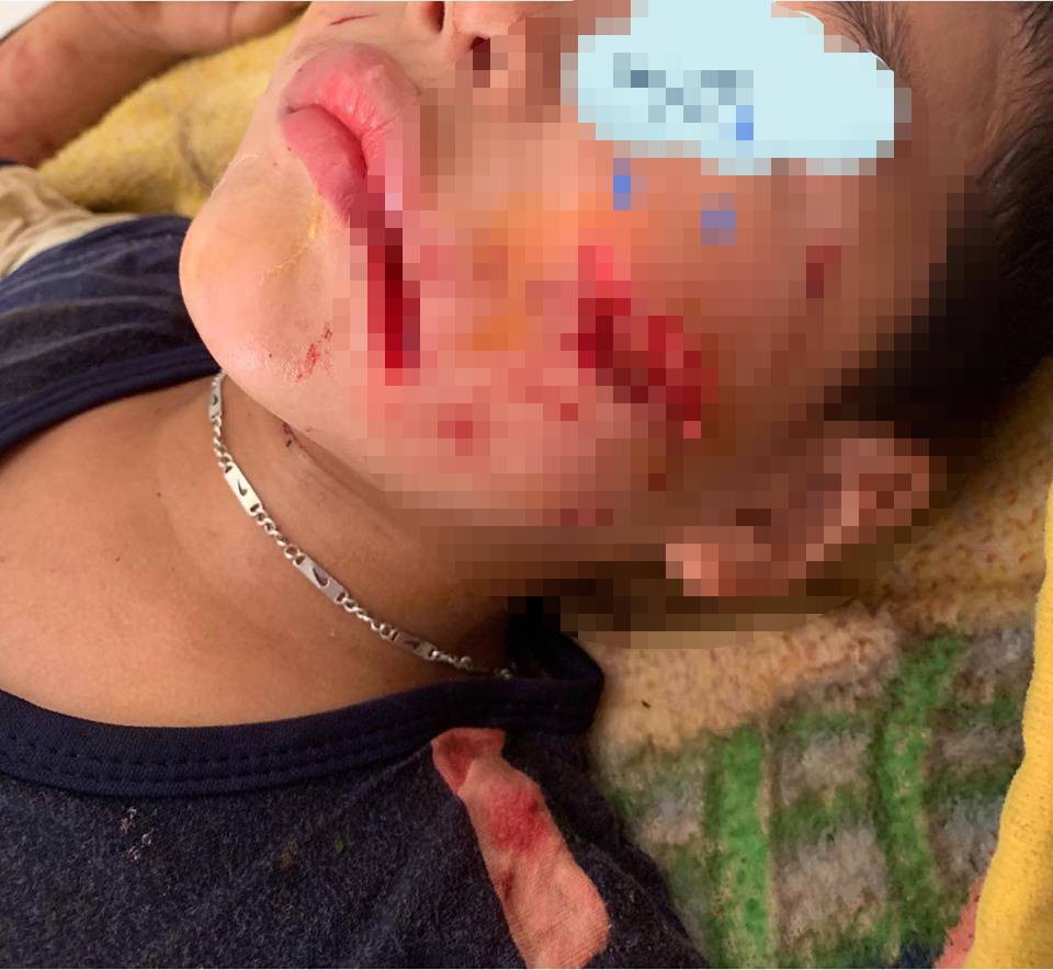 Bé trai 6 tuổi bị chó cắn vào mặt