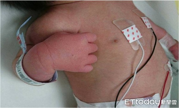 Bé trai 15 ngày tuổi sốt kéo dài, chân tay sưng đỏ vì mắc căn bệnh hiếm gặp  - Ảnh 1.