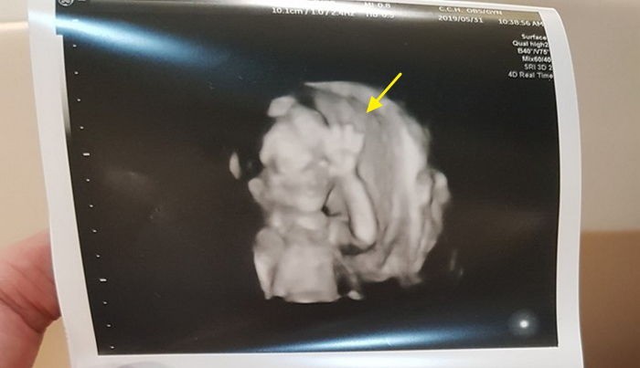 Chụp ảnh siêu âm mà giơ tay chào đủ kiểu, em bé từ trong bụng mẹ đã được dự đoán tương lai sau này vô cùng xán lạn - Ảnh 1.