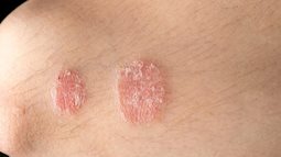 Cẩn thận với những căn bệnh về da thường gặp trong mùa hè, đặc biệt là bệnh số 3