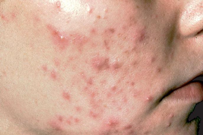 Cẩn thận với những căn bệnh về da thường gặp trong mùa hè, đặc biệt là bệnh số 3 - Ảnh 2.