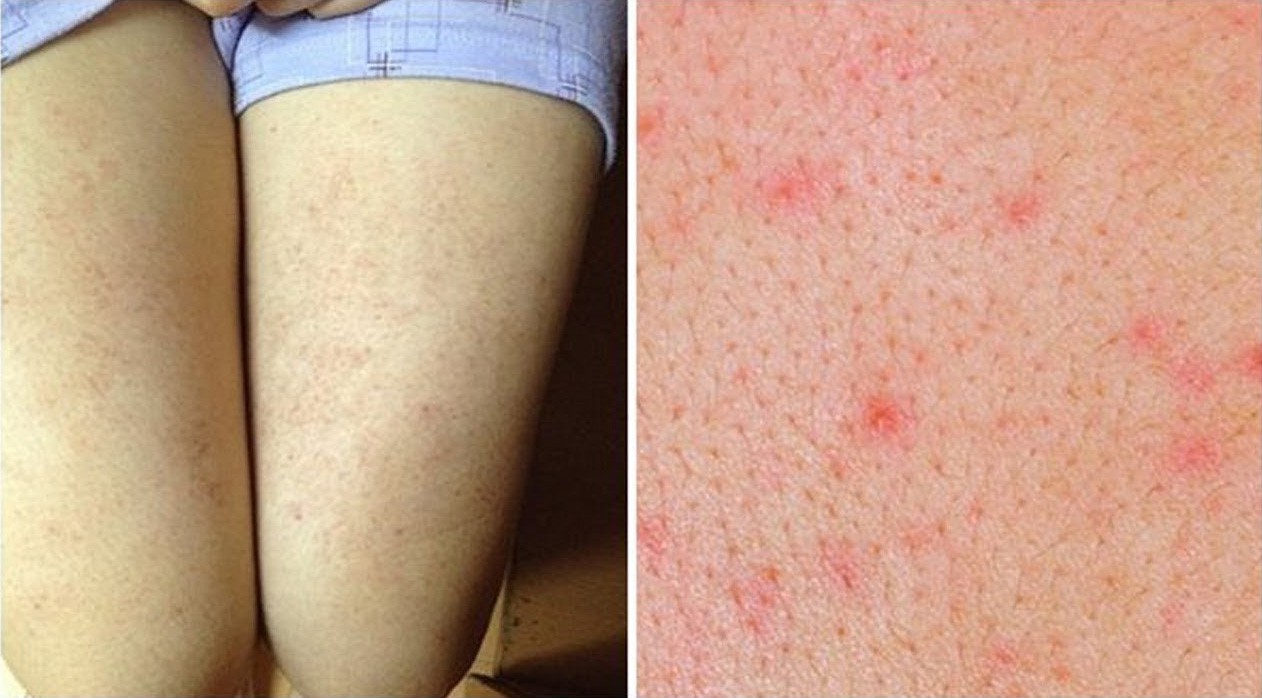 Cẩn thận với những căn bệnh về da thường gặp trong mùa hè, đặc biệt là bệnh số 3 - Ảnh 3.