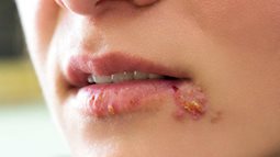 Quan hệ đường miệng - một trong những hành vi dễ lây lan bệnh tình dục nhất và đây là loạt bệnh bạn cần biết