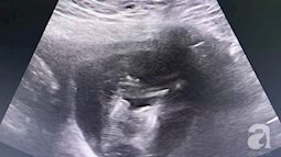 Phát hiện sớm cặp song thai dính nhau phức tạp ngay từ trong bụng mẹ