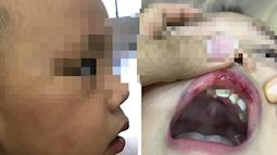 Cô giáo ở Hà Nội tát bé hơn 2 tuổi sấp mặt, tụ máu môi, bế ra góc khuất camera
