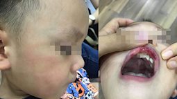 Cô giáo ở Hà Nội tát bé hơn 2 tuổi sấp mặt, tụ máu môi đang bị hoảng loạn và có suy nghĩ quẩn