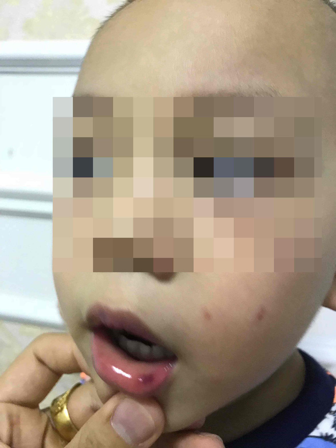 Lá thư xin lỗi gửi lúc đêm muộn của cô giáo ở Hà Nội tát bé hơn 2 tuổi sấp mặt, tụ máu môi - Ảnh 1.