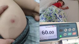 Trẻ 3 tuổi sốt cao, nhiễm trùng máu vì tự ý nặn mụn: Bác sĩ cảnh cáo 4 sai lầm bố mẹ hay làm có thể 'mất con'