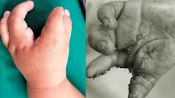 TP.HCM: Mẹ nghẹn ngào khi con trai 2 tuổi mắc 'hội chứng tôm hùm' vô cùng hiếm gặp khiến tay chân dị dạng