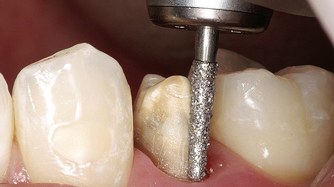 Cái giá của sự đẹp: Cận cảnh quy trình bọc răng sứ khiến người xem cũng phải thót tim - Ảnh 2.