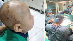 Nới rộng hộp sọ cứu bé 5 tháng không ngóc đầu lên được và có dấu hiệu nhỏ hơn bình thường