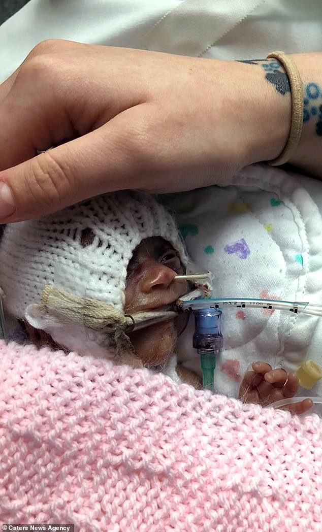 Sinh non trong toilet khi mới 24 tuần tuổi, bị chảy máu não, phổi nhưng bé gái vẫn sống sót kỳ diệu - Ảnh 2.