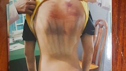 NÓNG: Tham dự khóa tu mùa hè, bé trai 11 tuổi nghi bị người tu hành xâm hại, đánh đập đến tím người tại Bình Thuận