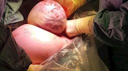 Mẹ hốt hoảng tưởng mình vừa sinh ra 'người ngoài hành tinh' khi nhìn con được bác sĩ mổ bắt thai