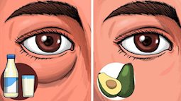 6 thực phẩm có thể khiến bọng mắt xuất hiện trên mặt bạn và 4 thực phẩm có tác dụng 'thổi bay' chúng