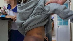 Bốn em nhỏ ở Cà Mau nghi bị người thân đánh thâm tím cơ thể