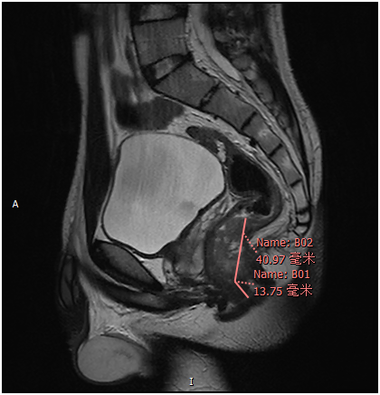 Chàng trai 17 tuổi phát hiện mình bị ung thư trực tràng thông qua những triệu chứng chẳng ai ngờ tới - Ảnh 2. Chàng trai 17 tuổi phát hiện mình bị ung thư trực tràng thông qua những triệu chứng chẳng ai ngờ tới - Ảnh 2.