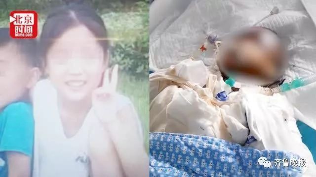 Bé gái 14 tuổi bị bỏng nặng do học làm bỏng ngô trên mạng đã qua đời, người nhà phát hiện con bắt chước 