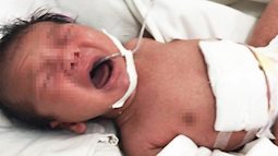 Nguy hiểm: Bé gái vừa sinh đã ói dịch vàng dịch xanh, giảm đến 0.5 kg chỉ sau một ngày vì dị tật hiếm gặp