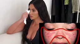 Mắc bệnh lupus ban đỏ như Kim Kardashian nguy hiểm thế nào?
