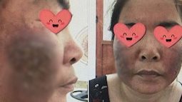 Mặt "nát" tanh bành chỉ vì ham hố trị nám bằng laser tại spa: Chuyên gia đưa ra cảnh báo ai cũng phải dè chừng