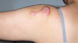 Không phải cứ thấy sẹo lồi lên là tiêm ngay để điều trị, chuyên gia cảnh báo điều mà hầu hết mọi người đang nhầm lẫn