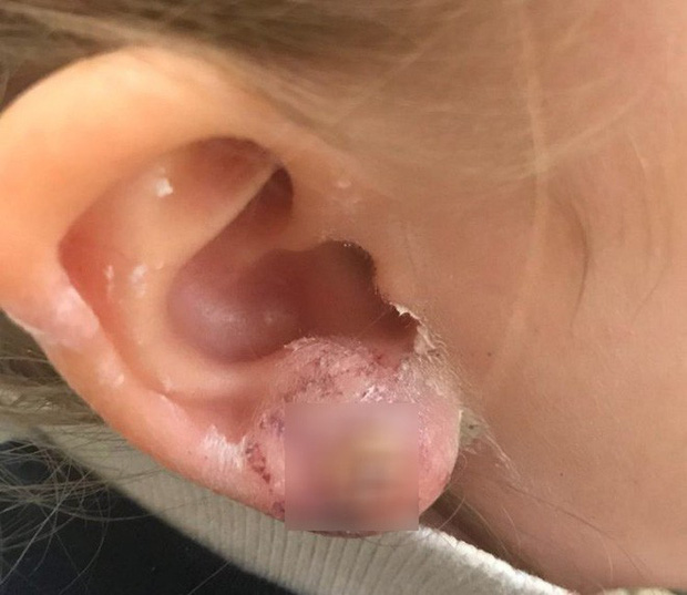 Cô bé 3 tuổi bị nhiễm trùng tai, thậm chí còn suýt mất đi tai trái chỉ vì đôi khuyên tai giá rẻ - Ảnh 3.