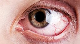 9 dấu hiệu bất thường trên đôi mắt cảnh báo bệnh tật nguy hiểm
