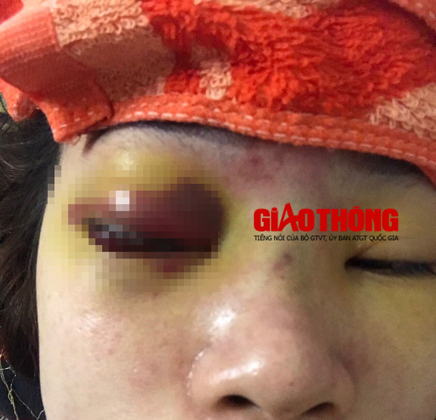 Bắc Giang: Nâng mũi tại cơ sở làm đẹp, cô gái bị mù vĩnh viễn - Ảnh 2.