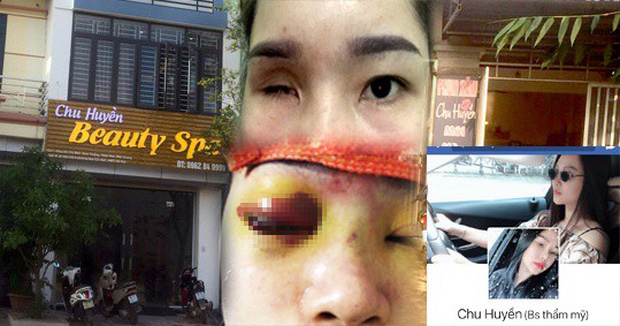 Bắc Giang: Nâng mũi tại cơ sở làm đẹp, cô gái bị mù vĩnh viễn - Ảnh 1.