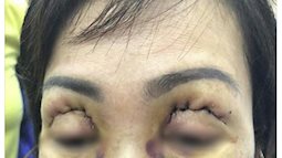 Những ca tai nạn kinh hoàng khi cắt mí mắt, nhấn mí ở spa chất lượng kém: Bài học đắt giá cho các chị em khi phẫu thuật thẩm mỹ