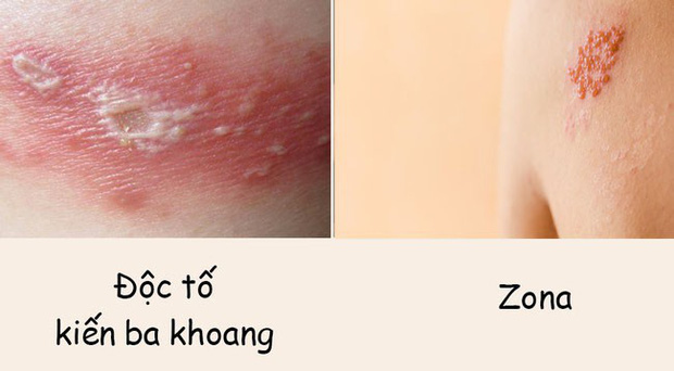 Phân biệt vết thương do kiến ba khoang với viêm da do zona để tránh dùng sai thuốc khiến bệnh càng khó chữa - Ảnh 1.