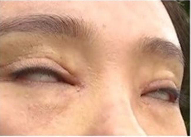 Chi hơn 40 triệu đi cắt mí, người phụ nữ gặp biến chứng khiến mắt không nhắm nổi - Ảnh 3.